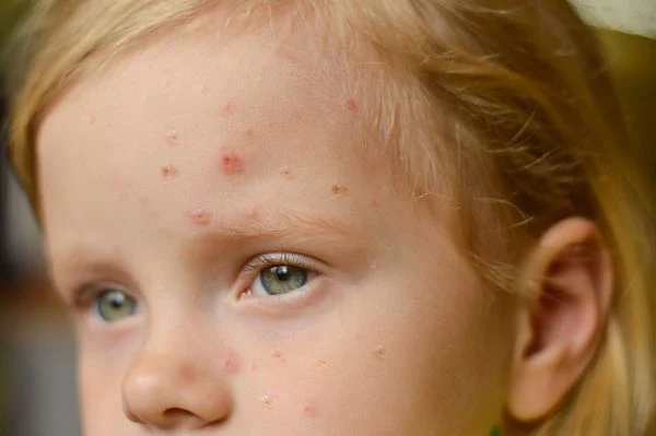 As lesões de pele começam como uma mancha vermelha, viram uma bolha e depois uma casquinha. Crédito: Shutterstock